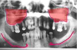 Крепкие зубы за один день - имплантация и протезирование методом All-on-Four | Cтоматологическая клиника доктора Шульте, г. Люцерн, Швейцария