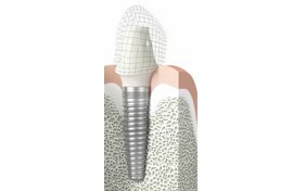 Крепкие зубы за один день - имплантация и протезирование методом All-on-Four | Cтоматологическая клиника доктора Шульте, г. Люцерн, Швейцария
