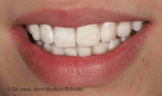 Отбеливание зубов | Cтоматологическая клиника доктора Шульте, г. Люцерн, Швейцария