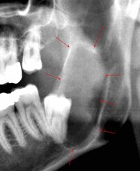Лечение челюстные кисты | Cтоматологическая клиника доктора Шульте, г. Люцерн, Швейцария