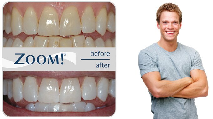Отбеливание зубов | Cтоматологическая клиника доктора Шульте, г. Люцерн, Швейцария