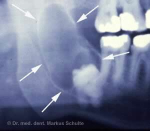 Лечение челюстные кисты | Cтоматологическая клиника доктора Шульте, г. Люцерн, Швейцария