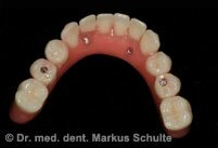 Экспресс-имплантация - «новые» зубы за одно посещение! | Cтоматологическая клиника доктора Шульте, г. Люцерн, Швейцария