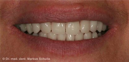 Экспресс-имплантация - «новые» зубы за одно посещение! | Cтоматологическая клиника доктора Шульте, г. Люцерн, Швейцария
