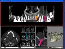 Швейцарские зубные имплантаты от надежных производителей | Cтоматологическая клиника доктора Шульте, г. Люцерн, Швейцария