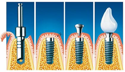 Швейцарские зубные имплантаты от надежных производителей | Cтоматологическая клиника доктора Шульте, г. Люцерн, Швейцария