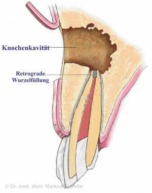 Резекция верхушки корня зуба| Cтоматологическая клиника доктора Шульте, г. Люцерн, Швейцария