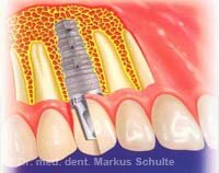 Современная имплантология: единичный зубной имплантат | Cтоматологическая клиника доктора Шульте, г. Люцерн, Швейцария