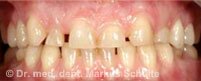 Современная имплантология: единичный зубной имплантат | Cтоматологическая клиника доктора Шульте, г. Люцерн, Швейцария