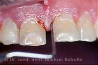 Пародонтология: здоровые дёсны для здоровых зубов | Cтоматологическая клиника доктора Шульте, г. Люцерн, Швейцария