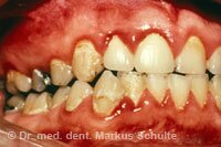 Пародонтология: здоровые дёсны для здоровых зубов | Cтоматологическая клиника доктора Шульте, г. Люцерн, Швейцария